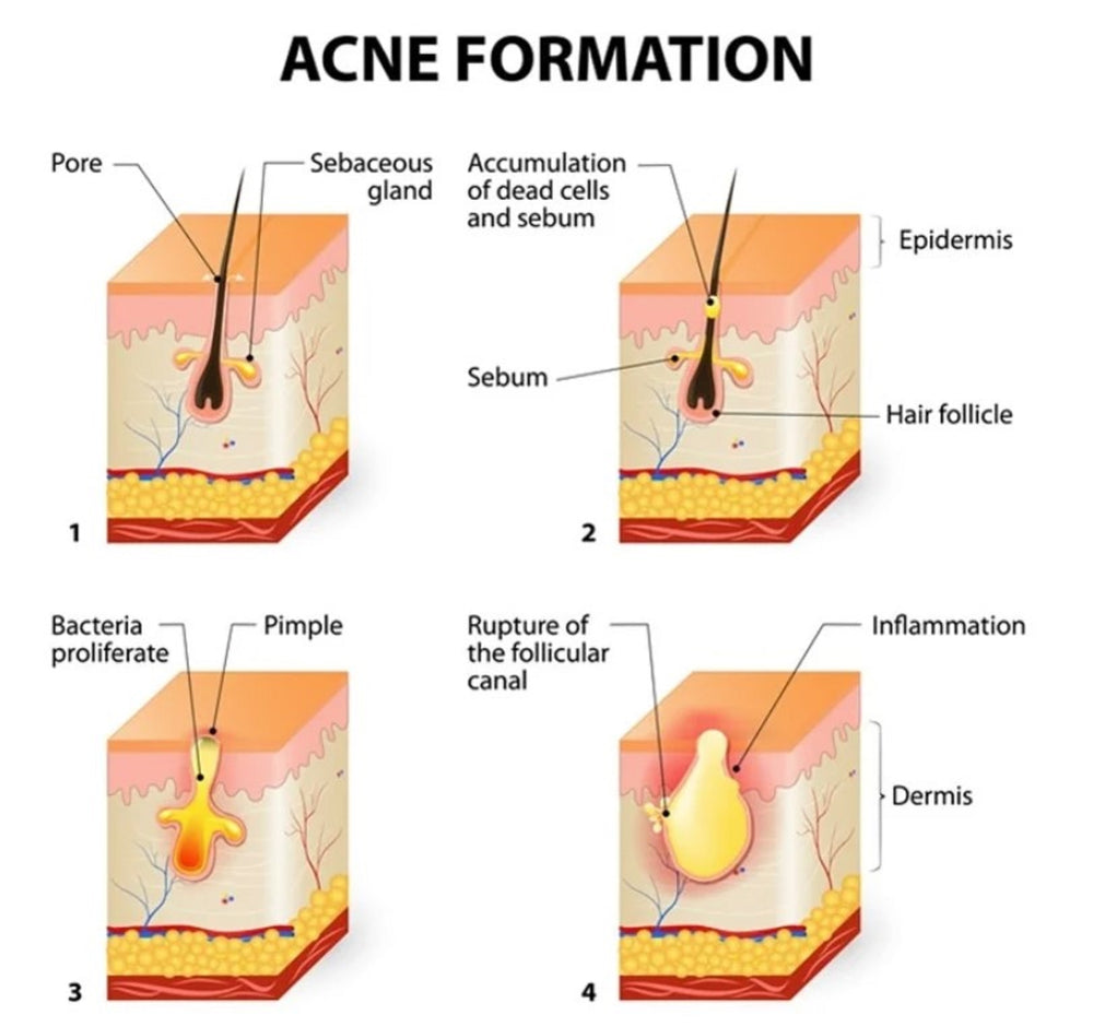 GET RID OF ACNE BACTERIA- ANTI ACNE - REMOVE ANY ACNE FROM YOUR FACE - GUMMIES - Made in USA