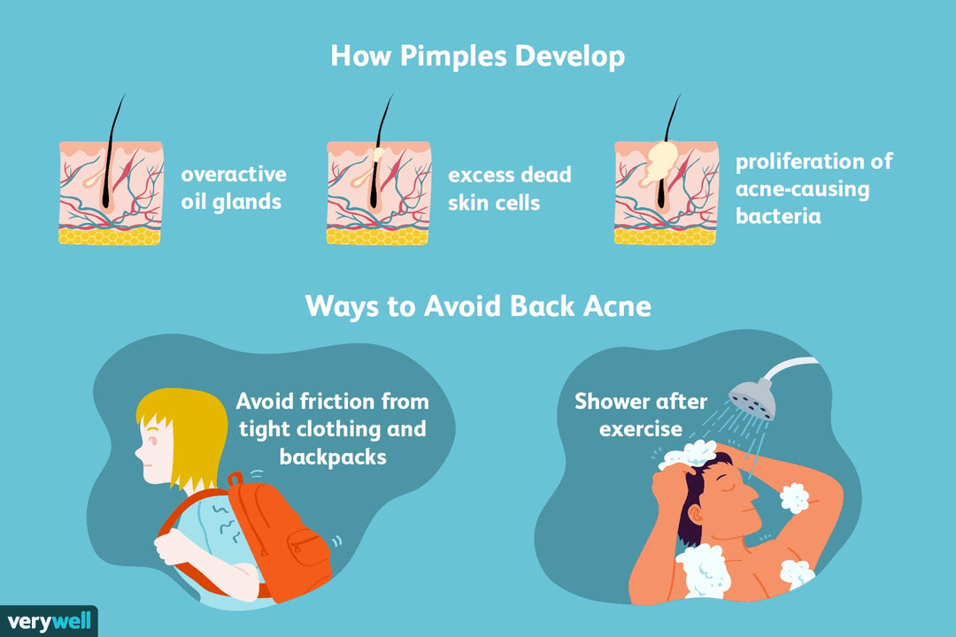 GET RID OF ACNE BACTERIA TREATMENT FOR MEN & WOMEN - Made in USA - 100% Natural