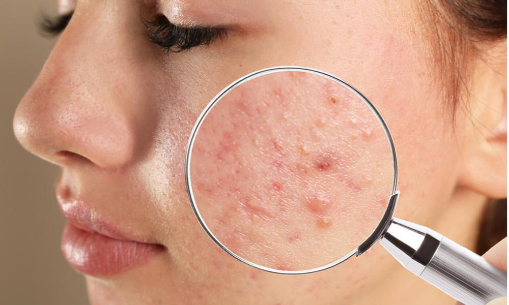GET RID OF ACNE BACTERIA TREATMENT FOR MEN & WOMEN - Made in USA - 100% Natural