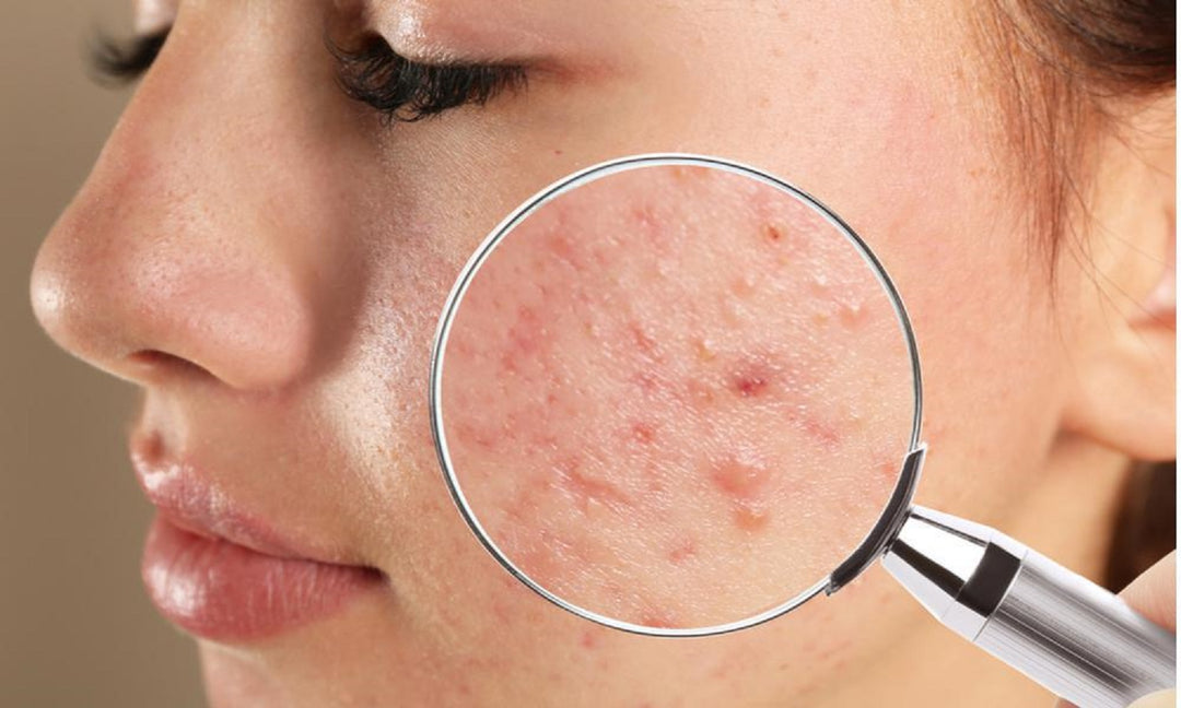 GET RID OF ACNE BACTERIA- ANTI ACNE - REMOVE ANY ACNE FROM YOUR FACE - GUMMIES - Made in USA