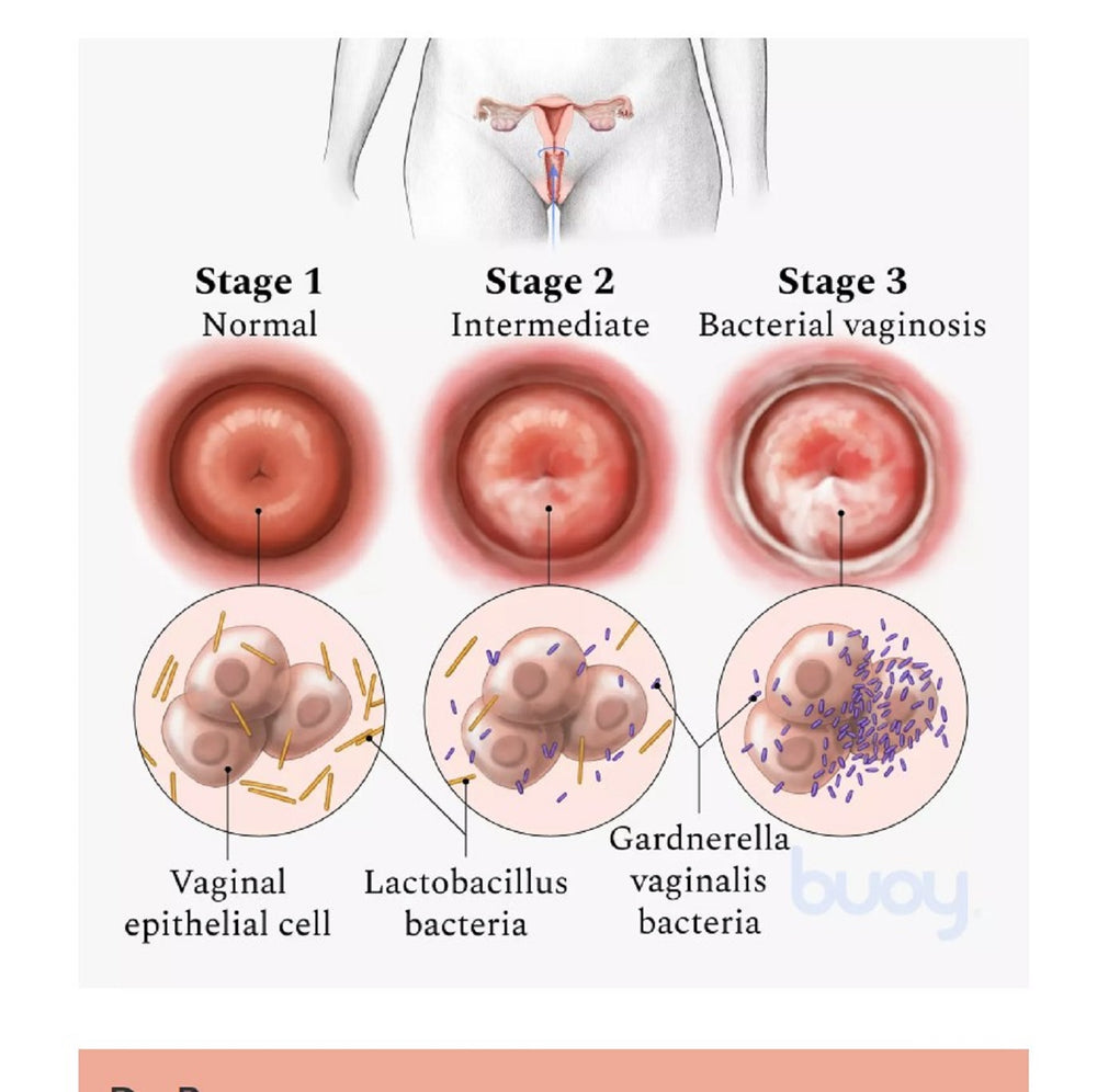 GET RID OF BACTERIAL VAGINOSIS INFECTION FOR WOMEN & MEN - Antibacterial, Anti-inflammatory MADE IN USA