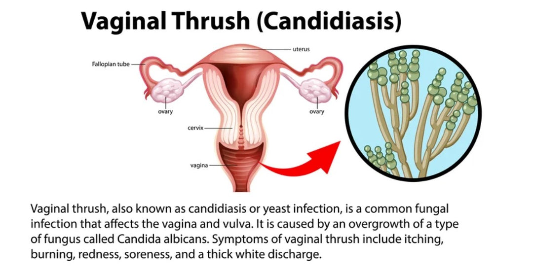 STOP CANDIDIASIS FUNGUS PAIN NOW- STRONGEST PAIN KILLER FOR CANDIDA ALBICANS - MADE IN USA
