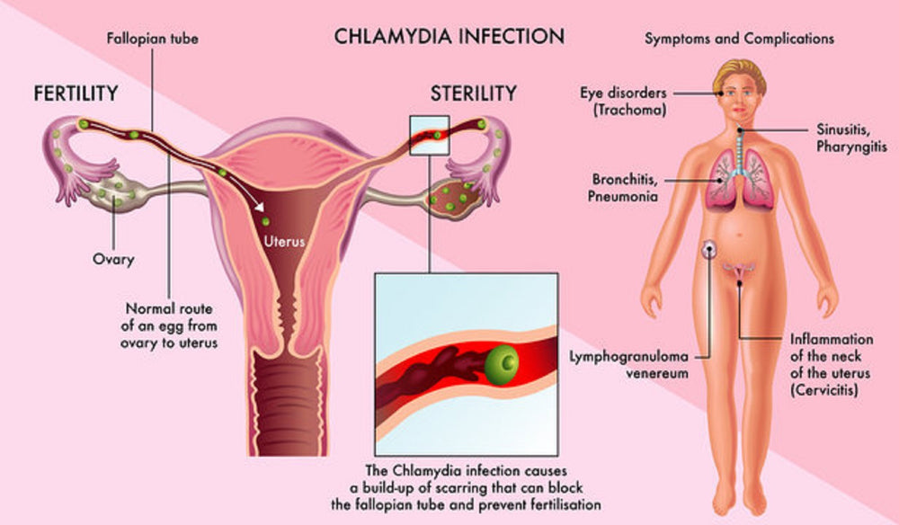 ELIMINAR LA CLAMIDIA GONORREA PAPILOMA INFECCION - SUPER ANTIBIOTICO NATURAL - MADE IN USA