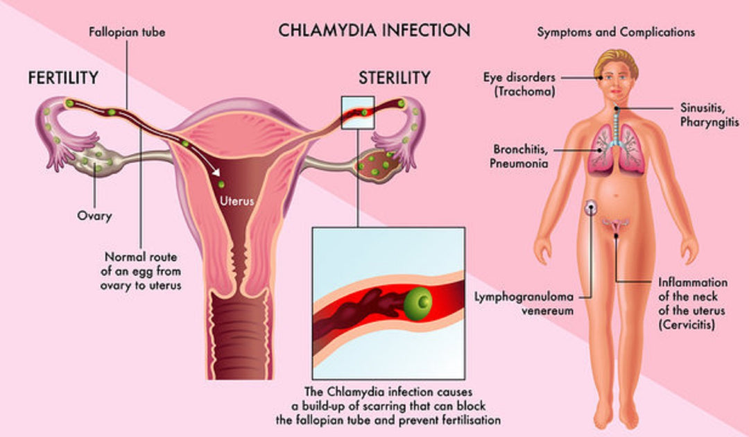 GET RID OF CHLAMYDIA BACTERIAL INFECTION - GUMMIES - TREAT & PREVENT - MEN & WOMEN antibacterial - MADE IN USA