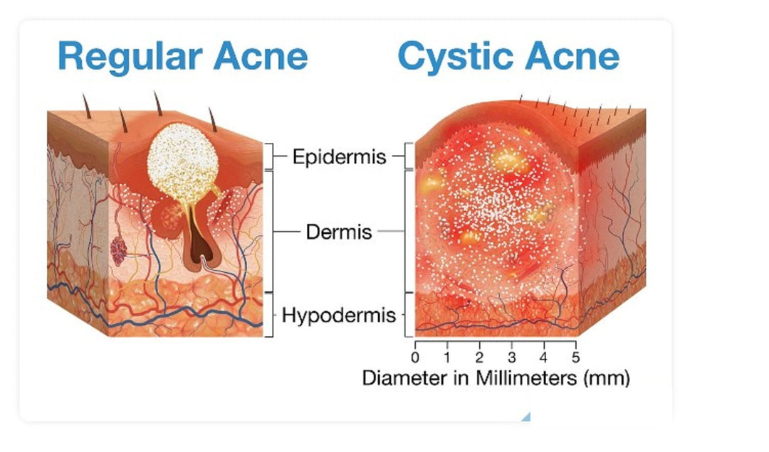 GET RID OF CYSTIC ACNE BACTERIAL - REMOVE ANY CYST - Made in USA -