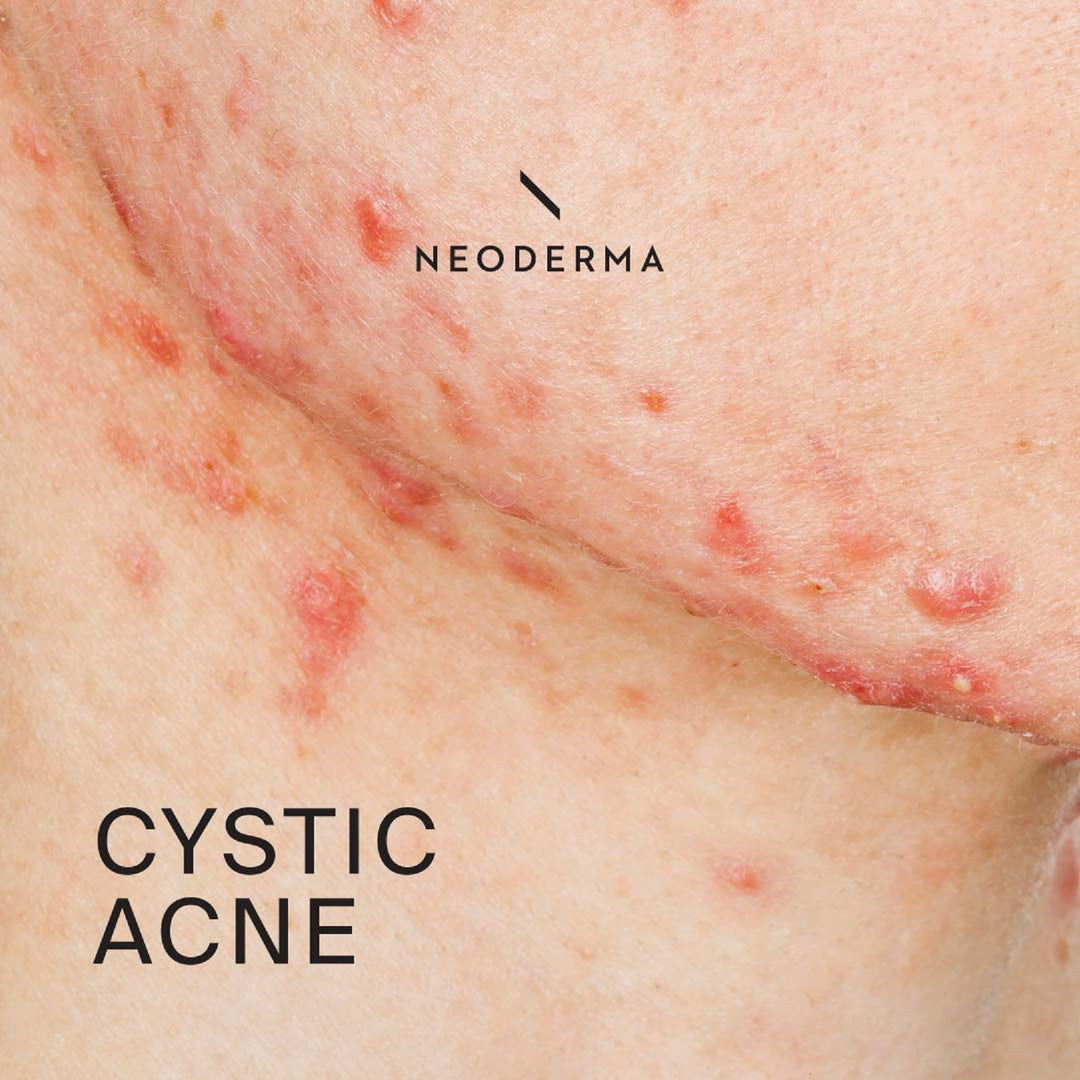 GET RID OF CYSTIC ACNE BACTERIAL - REMOVE ANY CYST - Made in USA -