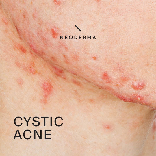 GET RID OF CYSTIC ACNE BACTERIAL - REMOVE ANY CYST - Made in USA -