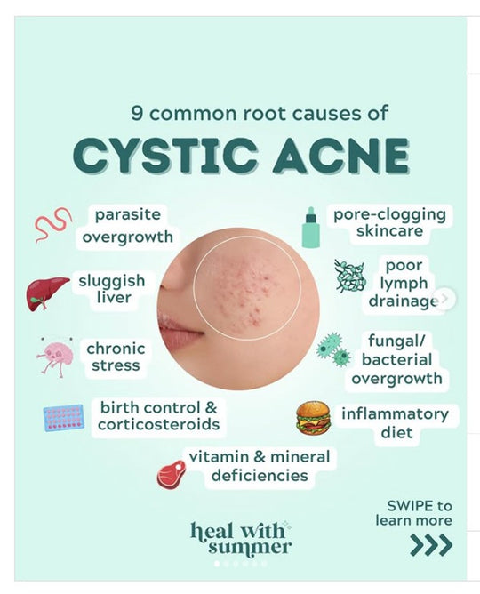 GET RID OF CYSTIC ACNE BACTERIAL - REMOVE ANY CYST ACNE FROM YOUR FACE - GUMMIES - Made in USA