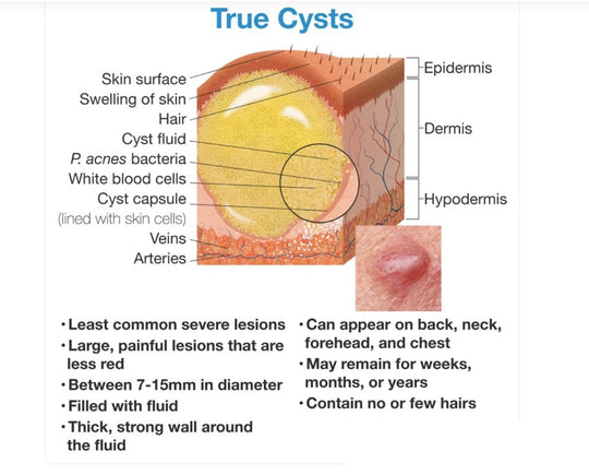 GET RID OF CYSTIC ACNE BACTERIAL - REMOVE ANY CYST ACNE FROM YOUR FACE - GUMMIES - Made in USA