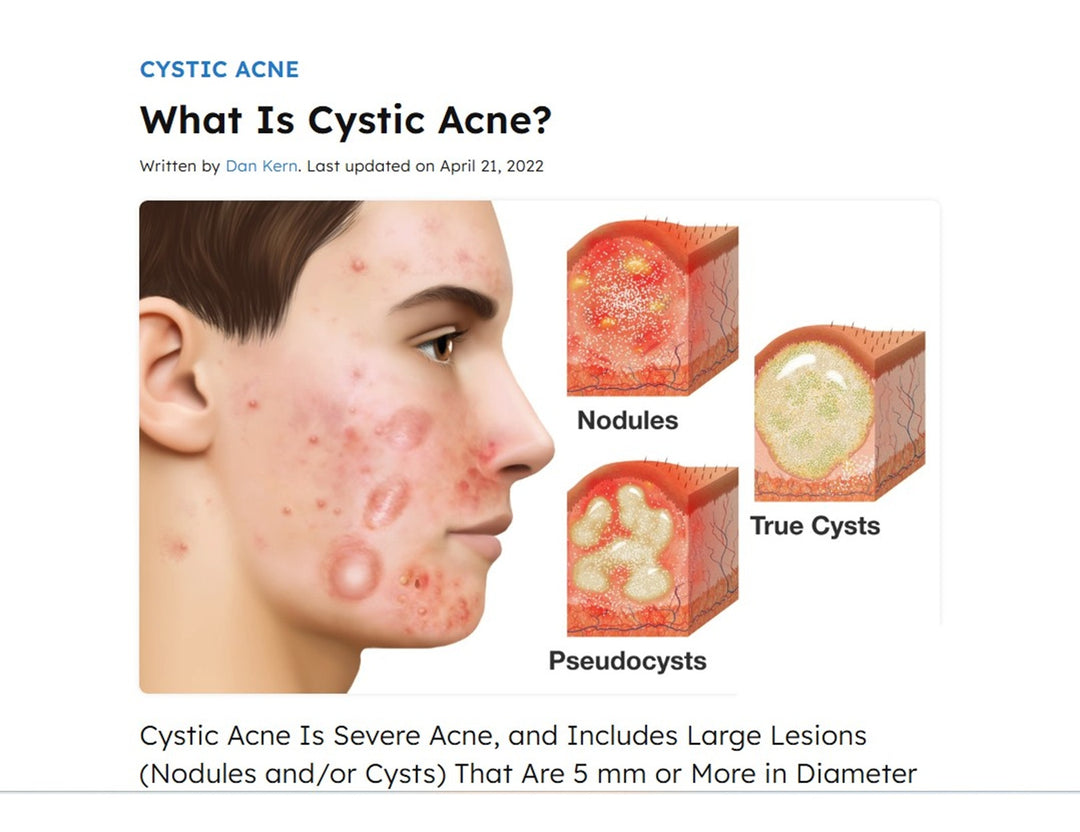 GET RID OF CYSTIC ACNE BACTERIAL - REMOVE ANY CYST ACNE FROM YOUR FACE - GUMMIES - Made in USA