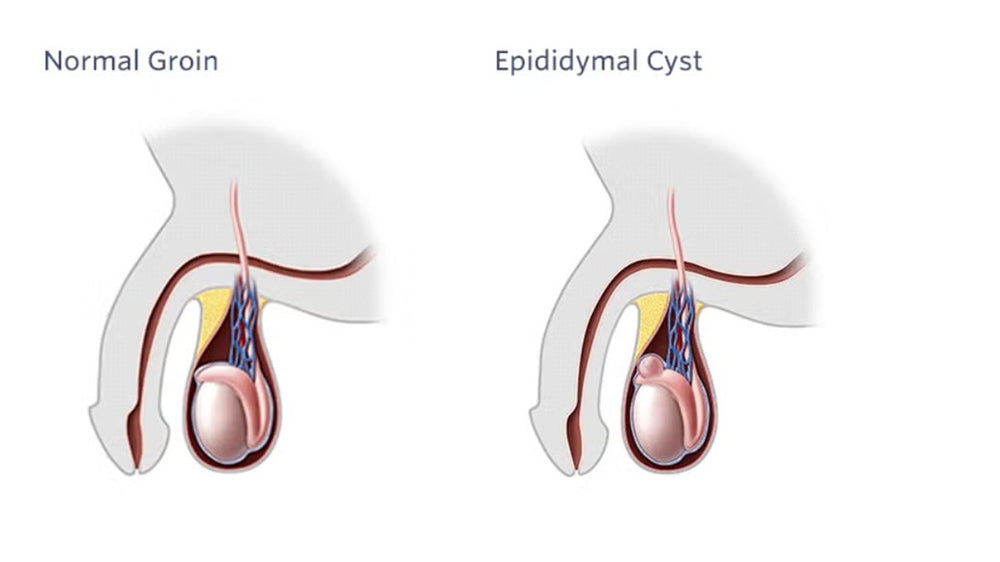 GET RID OF EPIDIDYMAL CYST NATURALLY - ELIMINATE ANY CYST - EPIDIDYMITIS - Made in USA
