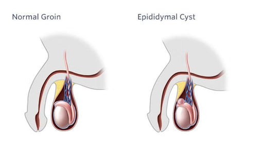 GET RID OF EPIDIDYMAL CYST NATURALLY - ELIMINATE ANY CYST - EPIDIDYMITIS - Made in USA