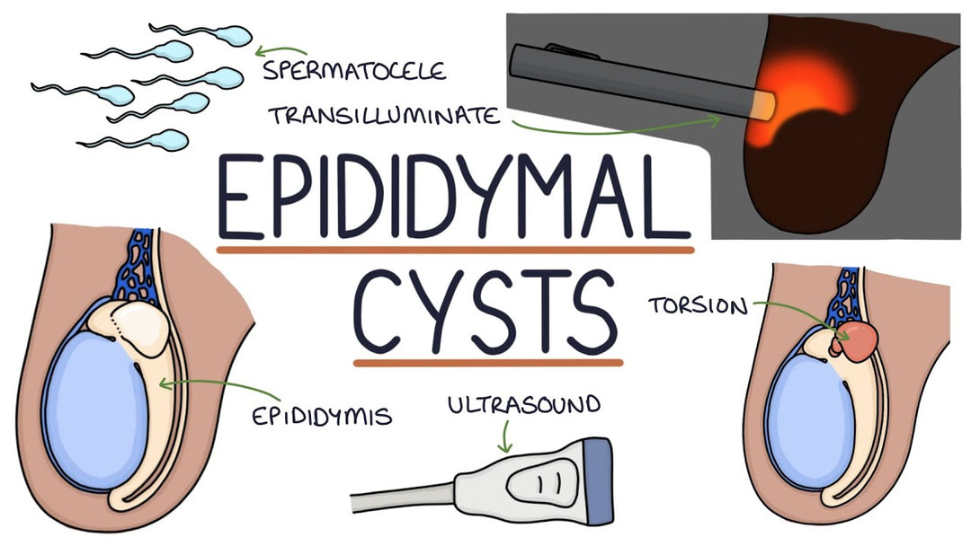 GET RID OF EPIDIDYMAL CYST NATURALLY - ELIMINATE ANY CYST - EPIDIDYMITIS - Made in USA