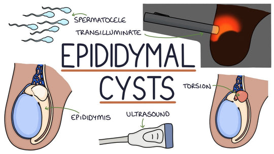 GET RID OF EPIDIDYMAL CYST NATURALLY - ELIMINATE ANY CYST - EPIDIDYMITIS - Made in USA