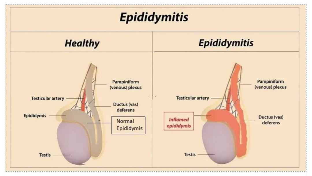 GET RID OF EPIDIDYMAL CYST NATURALLY - ELIMINATE ANY CYST - EPIDIDYMITIS - Made in USA