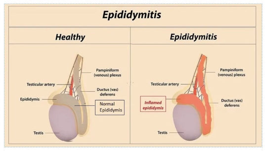 GET RID OF EPIDIDYMAL CYST NATURALLY - ELIMINATE ANY CYST - EPIDIDYMITIS - Made in USA