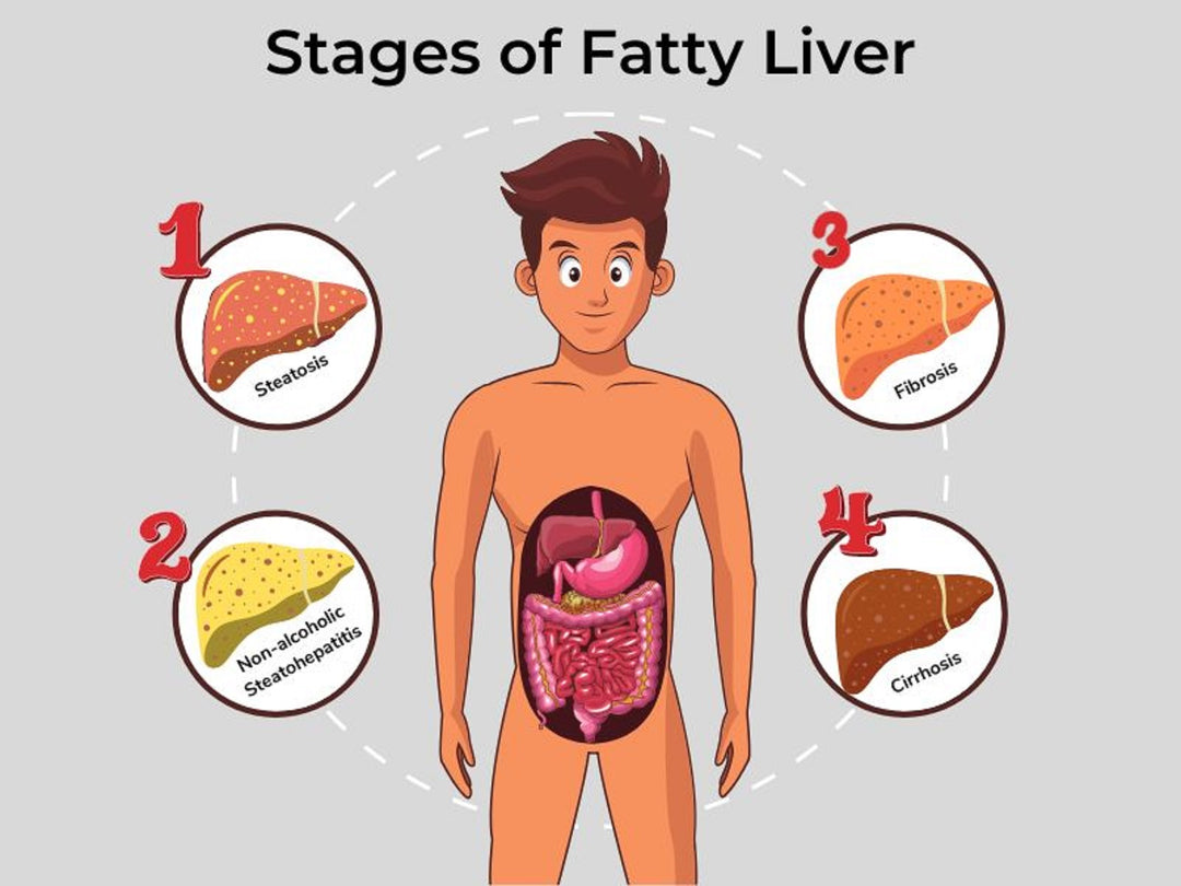 GET RID OF FATTY LIVER NATURALLY - ELIMINATE FATTY TISSUE - ANTI INFLAMMATORY - MADE IN USA