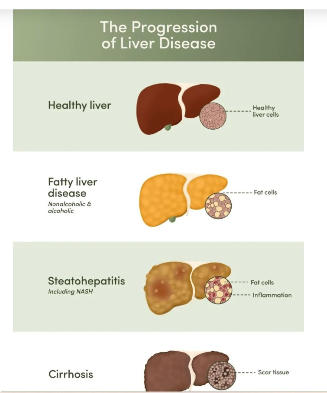 GET RID OF FATTY LIVER NATURALLY - STRONG DETOXING LIVER - MADE IN USA