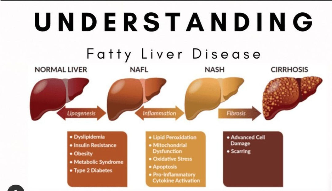 GET RID OF FATTY LIVER NATURALLY - STRONG DETOXING LIVER - MADE IN USA