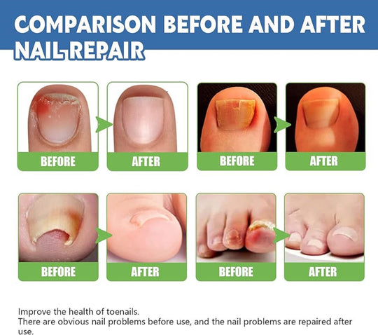 ELIMINATE ToeNails FUNGUS & SKIN Fungus Cream - SUPER STRENGTH (HONGOCID) 15 g Tube
