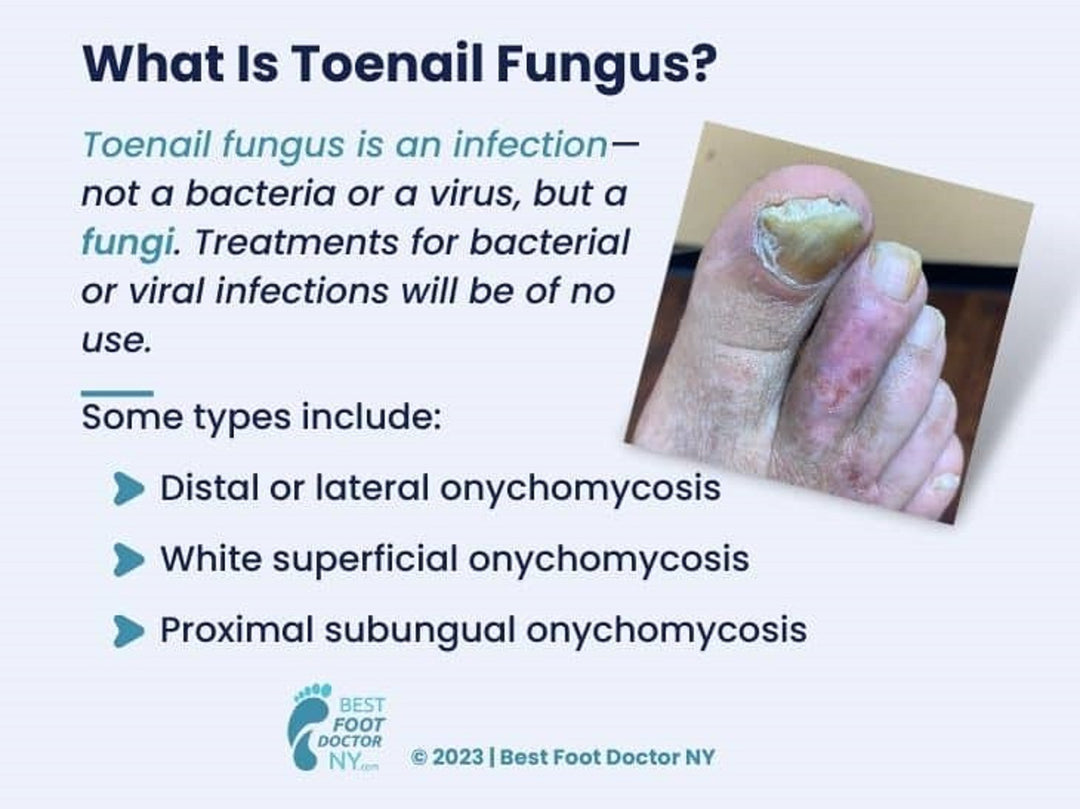 ELIMINATE ToeNails FUNGUS & SKIN Fungus Cream - SUPER STRENGTH (HONGOCID) 15 g Tube