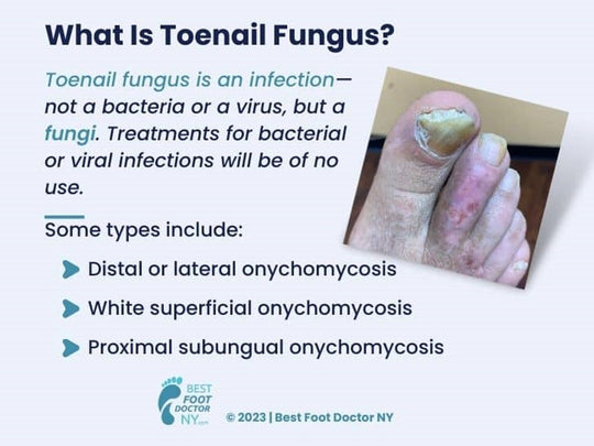 ELIMINATE ToeNails FUNGUS & SKIN Fungus Cream - SUPER STRENGTH (HONGOCID) 15 g Tube