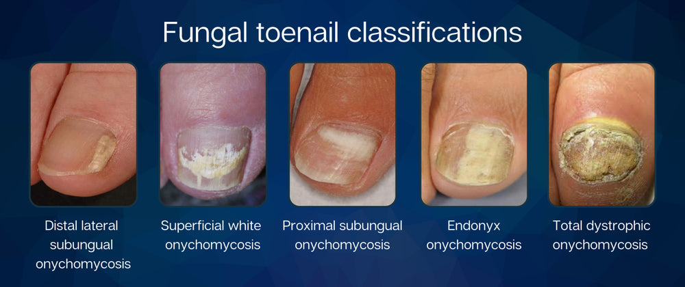 ELIMINATE ToeNails FUNGUS & SKIN Fungus Cream - SUPER STRENGTH (HONGOCID) 15 g Tube