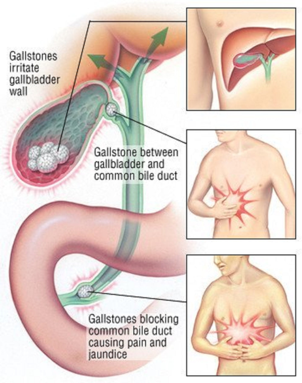 GET RID OF GALLBLADDER STONES & KIDNEY STONES - HERBAL STONES BREAKER - MADE IN USA