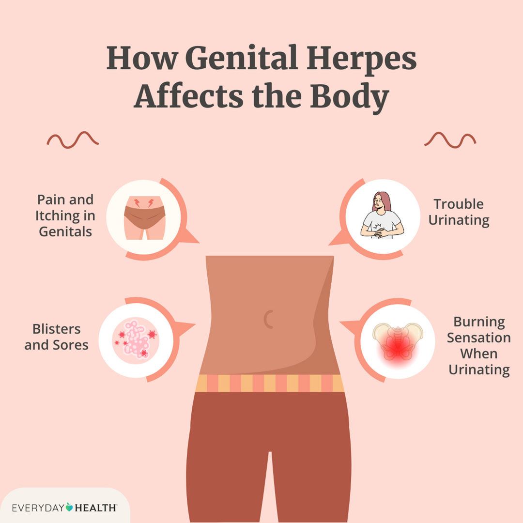 STOP THE GENITAL HERPES 1 & 2 PAIN NOW - EXTRA STRENGTH - STRONGEST PAIN KILLER -MADE IN USA