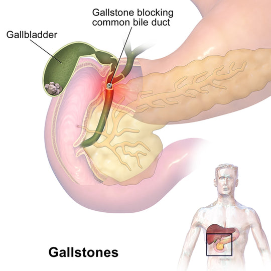 GET RID OF GALLBLADDER STONES NOW - GALLSTONES BREAKER -  BEST HERBAL FORMULA - MADE IN USA