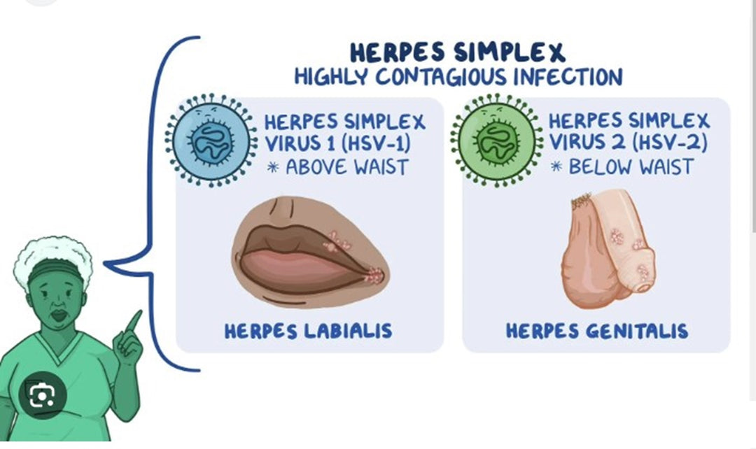 STOP THE GENITAL HERPES 1 & 2 PAIN NOW - EXTRA STRENGTH - STRONGEST PAIN KILLER -MADE IN USA