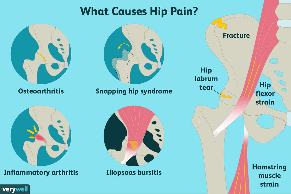 STOP HIP JOINT PAIN RIGHT NOW  - hip dysplasia , arthritis - STRONGEST PAIN KILLER IN CREAM - MADE IN USA