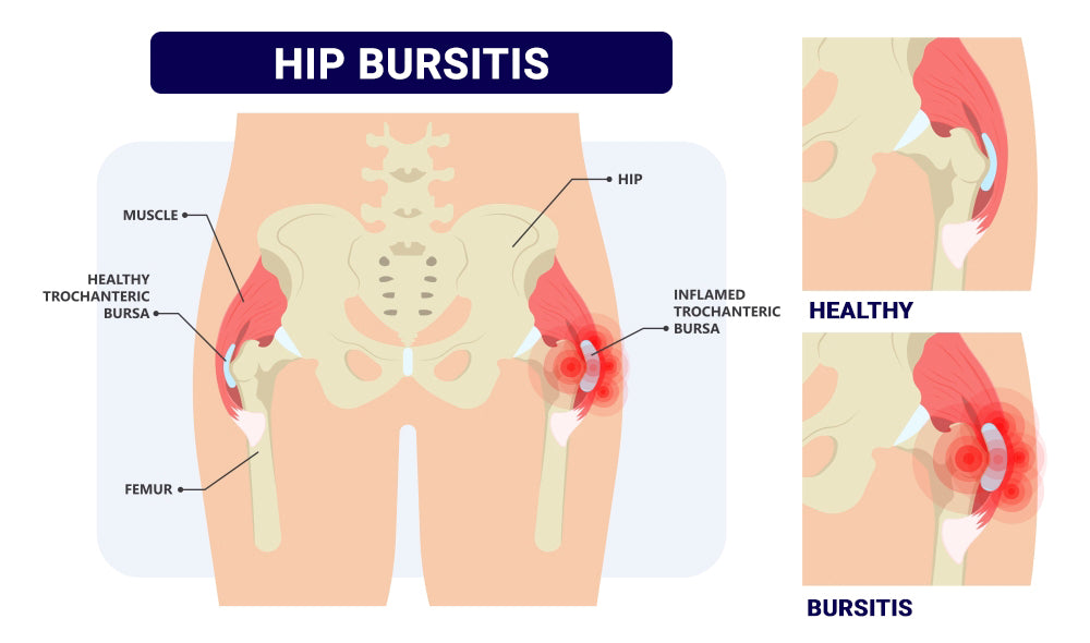 STOP HIP JOINT PAIN RIGHT NOW - hip dysplasia , arthritis - STRONGEST PAIN KILLER - MADE IN USA