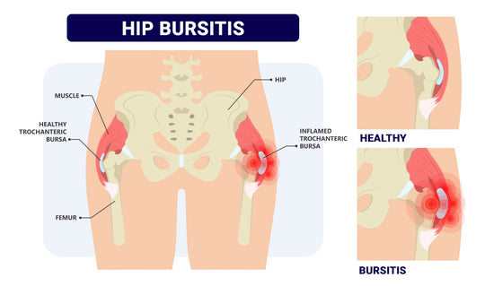 STOP HIP JOINT PAIN RIGHT NOW  - hip dysplasia , arthritis - STRONGEST PAIN KILLER IN CREAM - MADE IN USA