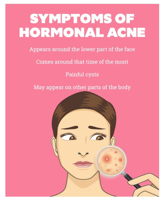 GET RID OF ACNE HORMONAL FOR WOMEN - BALANCE THE ESTROGEN & PROGESTERONE LEVELS - MADE IN USA