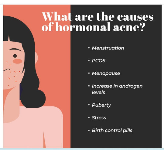 GET RID OF ACNE HORMONAL FOR WOMEN - BALANCE THE ESTROGEN & PROGESTERONE LEVELS - MADE IN USA