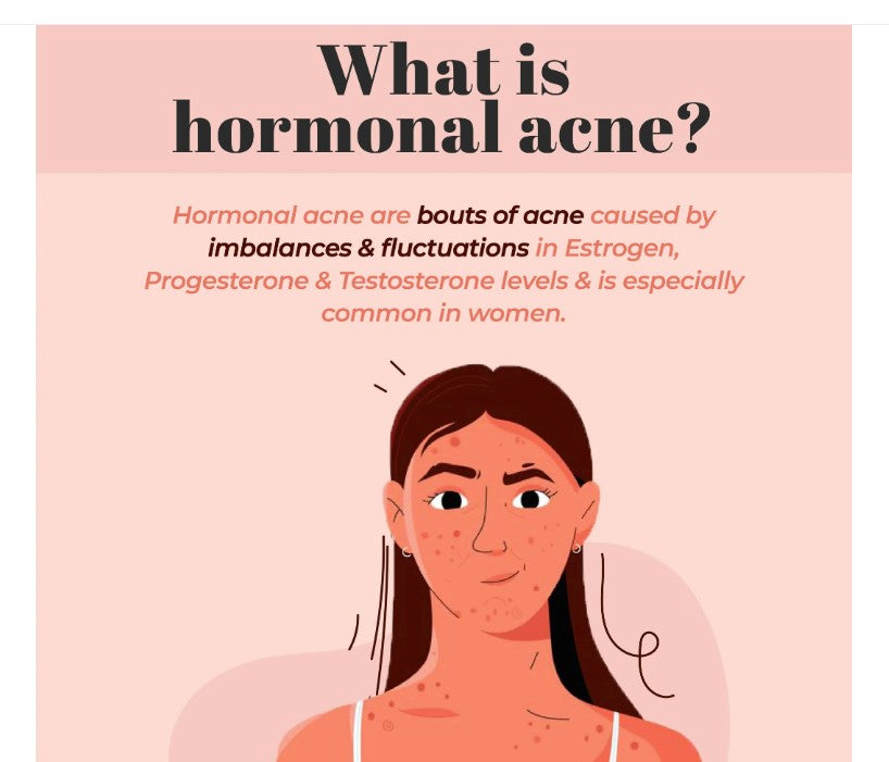 GET RID OF ACNE HORMONAL FOR WOMEN - BALANCE THE ESTROGEN & PROGESTERONE LEVELS - MADE IN USA