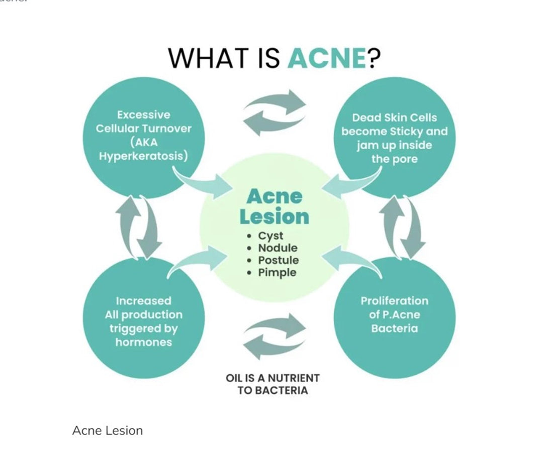 GET RID OF ACNE HORMONAL FOR MEN - BALANCE THE OVERPRODUCTION OF TESTOSTERONE - MADE IN USA