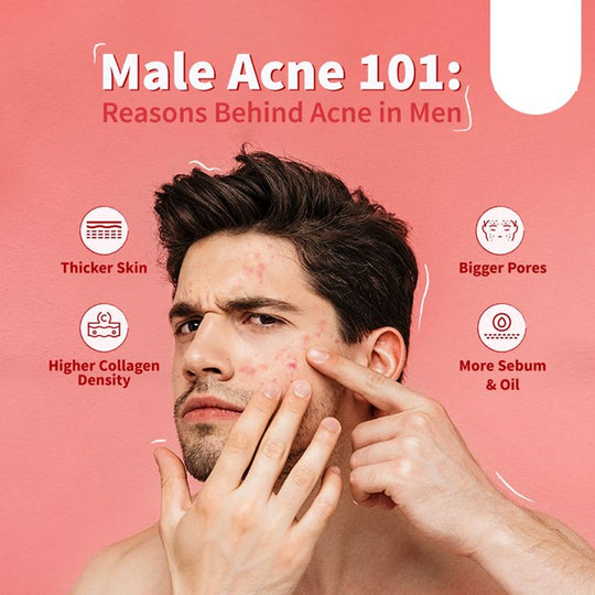GET RID OF ACNE HORMONAL FOR MEN - BALANCE THE OVERPRODUCTION OF TESTOSTERONE - MADE IN USA
