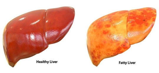 GET RID OF FATTY LIVER NATURALLY - STRONG DETOXING LIVER - MADE IN USA