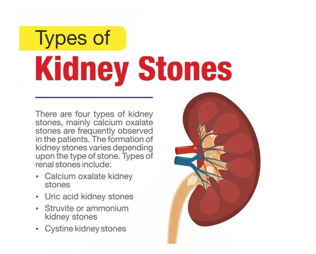 GET RID OF KIDNEY STONES RIGHT NOW - KIDNEY STONE BREAKER - STOP PAIN - Treat & Prevent - MADE IN USA