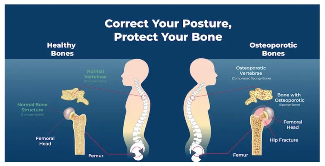 SLOW DOWN OSTEOPOROSIS DISEASE - STOP BONE LOSS NATURALLY - SUPER BONE BOOSTER BUILDER - MADE IN USA