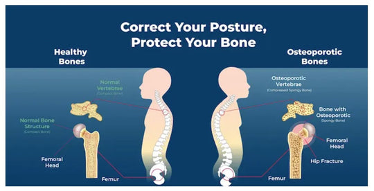 SLOW DOWN OSTEOPOROSIS DISEASE - STOP BONE LOSS NATURALLY - SUPER BONE BOOSTER BUILDER - MADE IN USA