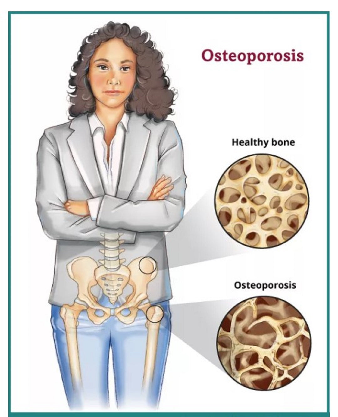 SLOW DOWN OSTEOPOROSIS DISEASE - STOP BONE LOSS NATURALLY - SUPER BONE BOOSTER BUILDER - MADE IN USA