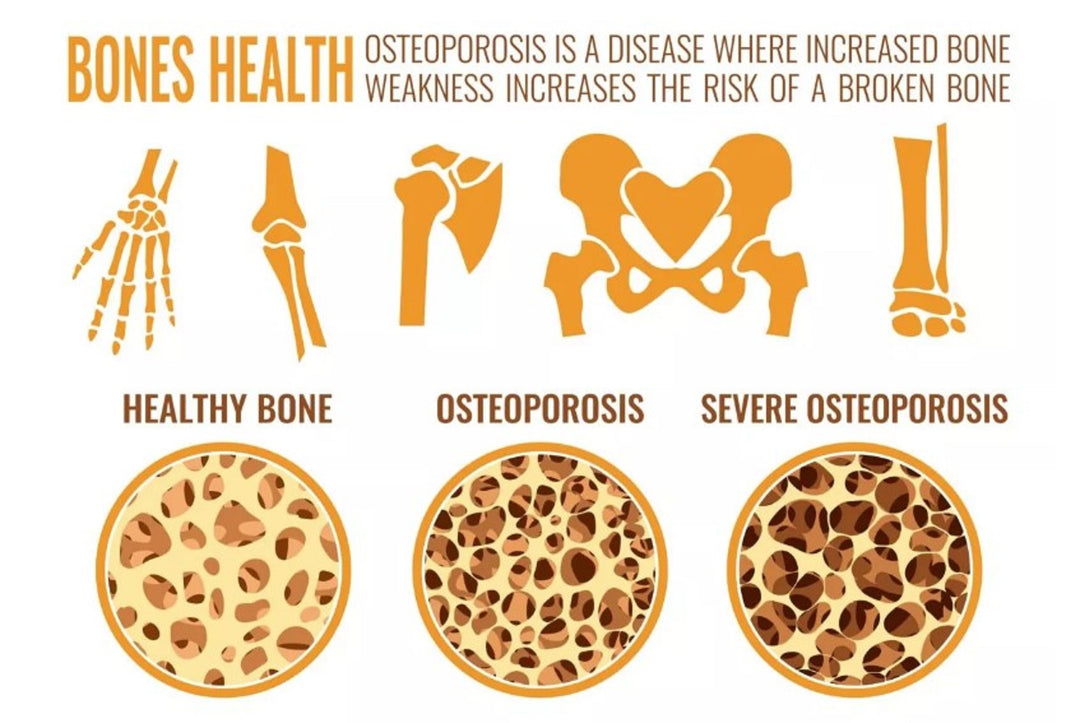 SLOW DOWN OSTEOPOROSIS DISEASE - STOP BONE LOSS NATURALLY - SUPER BONE BOOSTER BUILDER - MADE IN USA