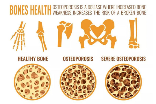 SLOW DOWN OSTEOPOROSIS DISEASE - STOP BONE LOSS NATURALLY - SUPER BONE BOOSTER BUILDER - MADE IN USA