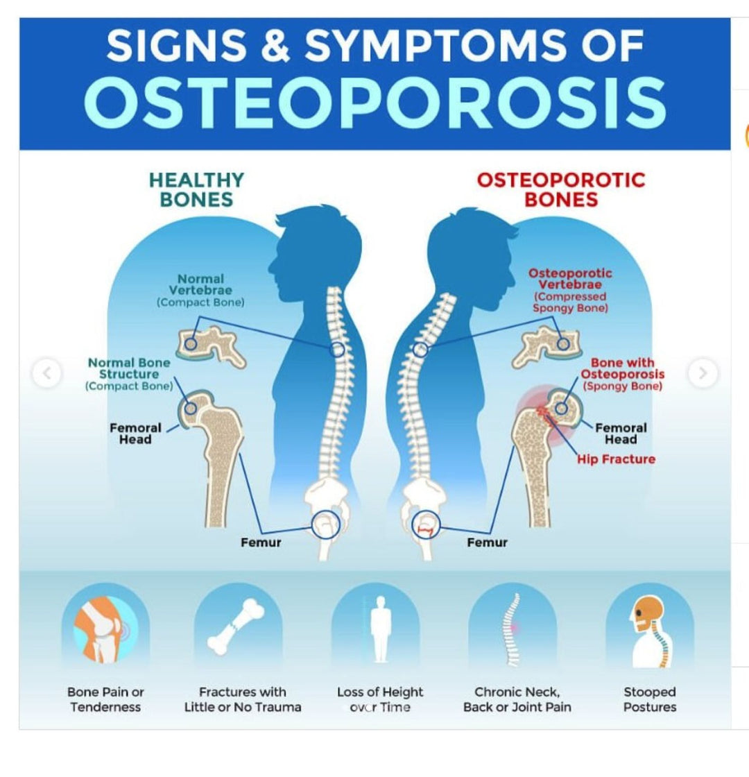SLOW DOWN OSTEOPOROSIS DISEASE - STOP BONE LOSS NATURALLY - SUPER BONE BOOSTER BUILDER - MADE IN USA