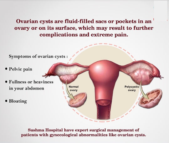 GET RID OF OVARIAN CYST NATURALLY - ELIMINATE ANY CYST IN YOUR BODY - MADE IN USA