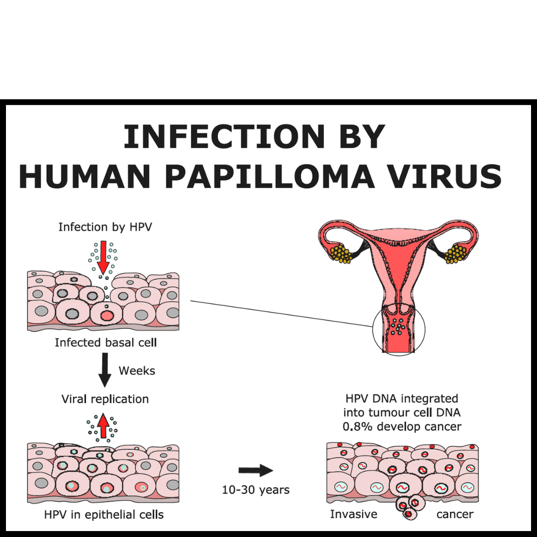 GET RID OF PAPILLOMA HPV INFECTION RIGHT AWAY - KILL THE PAPILLOMA VIRUS NATURALLY -MADE IN USA