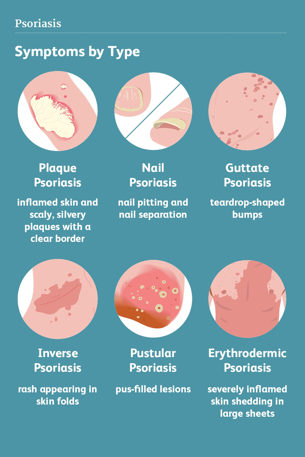 GET RID OF PSORIASIS SKIN DISEASE NOW -Struggling With Psoriasis? This is the best natural solution- Made in USA
